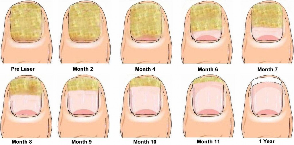 The Top 5 Reasons Why People Get Fungal Nail Infections Tgdaily 