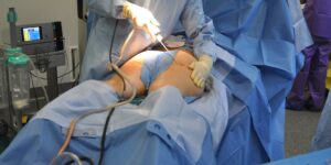 liposuction lipoaspiration plastic surgery surgery surgeon