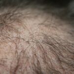 Hair Loss: A Very Common Problem in Men