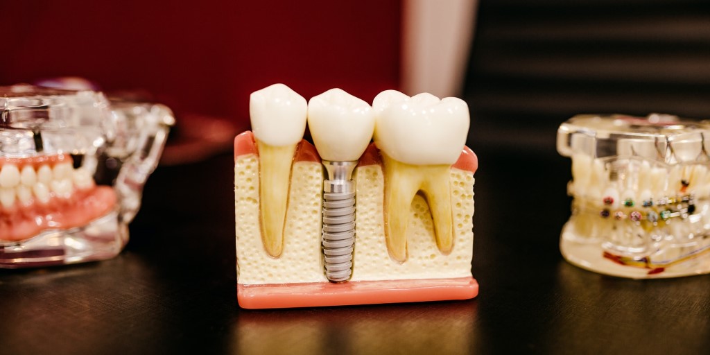 Dental Implants 101: Consulting a Dentist in Flagstaff, AZ