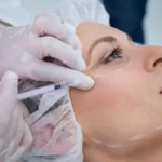 woman-with-marked-face-receiving-botox-injection